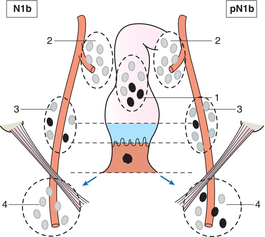 Schematic illustration of Metastases in external iliac nodes.