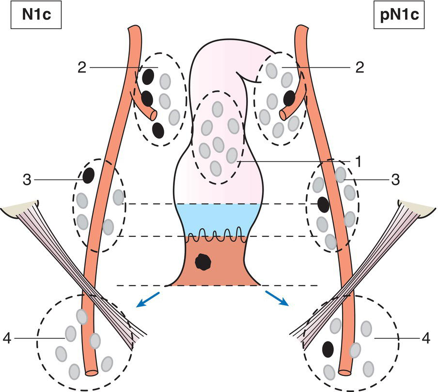 Schematic illustration of Metastases in external iliac and in inguinal, mesorectal and internal iliac nodes.