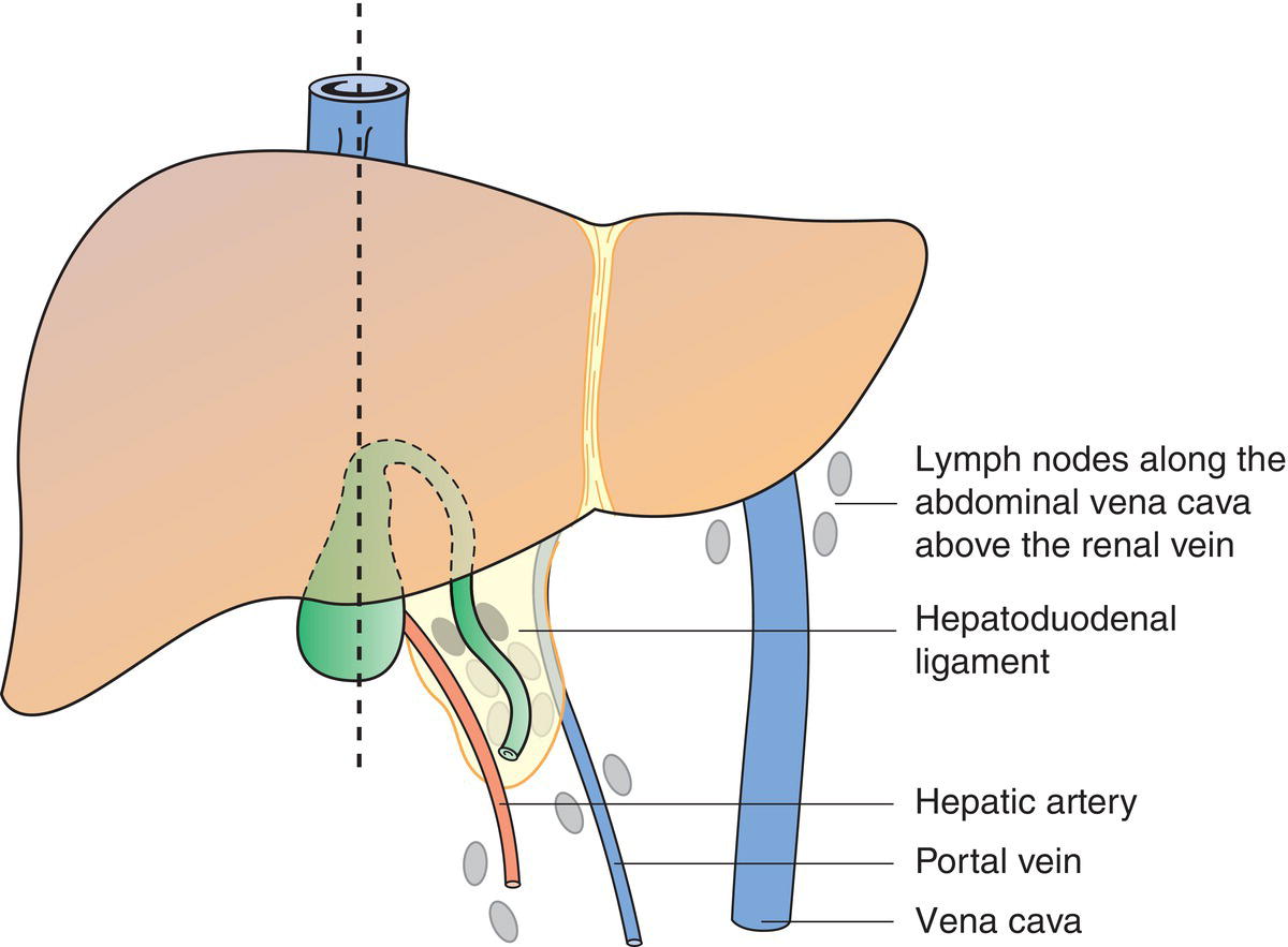 Schematic illustration of Lymph nodes along the
abdominal vena cava
above the renal vein.