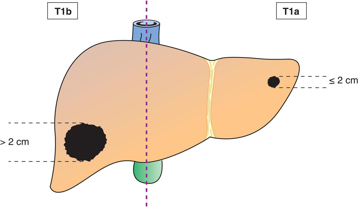 Schematic illustration of Solitary tumour less than or equal to 2 cm in greatest dimension with or without vascular invasion.