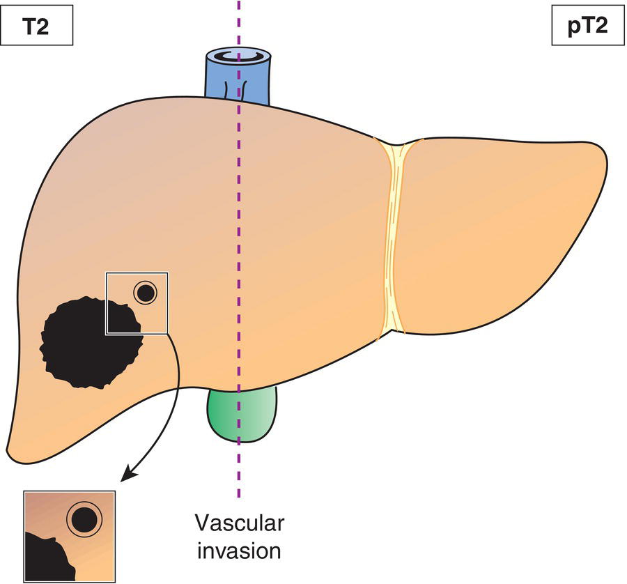 Schematic illustration of Solitary tumour with vascular invasion or multiple tumours, none more than 5 cm in greatest dimension.