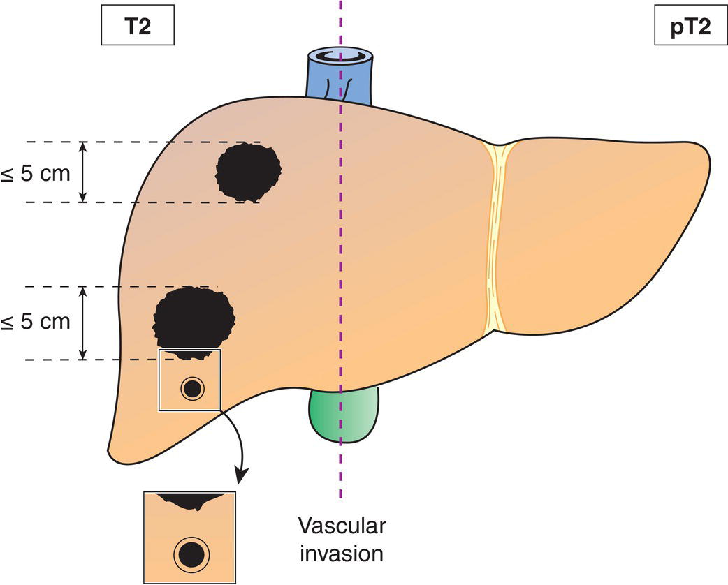 Schematic illustration of Solitary tumour with vascular invasion or multiple tumours, none more than 5 cm in greatest dimension.