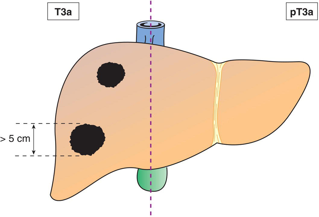 Schematic illustration of Multiple tumours any more than 5 cm in greatest dimension.