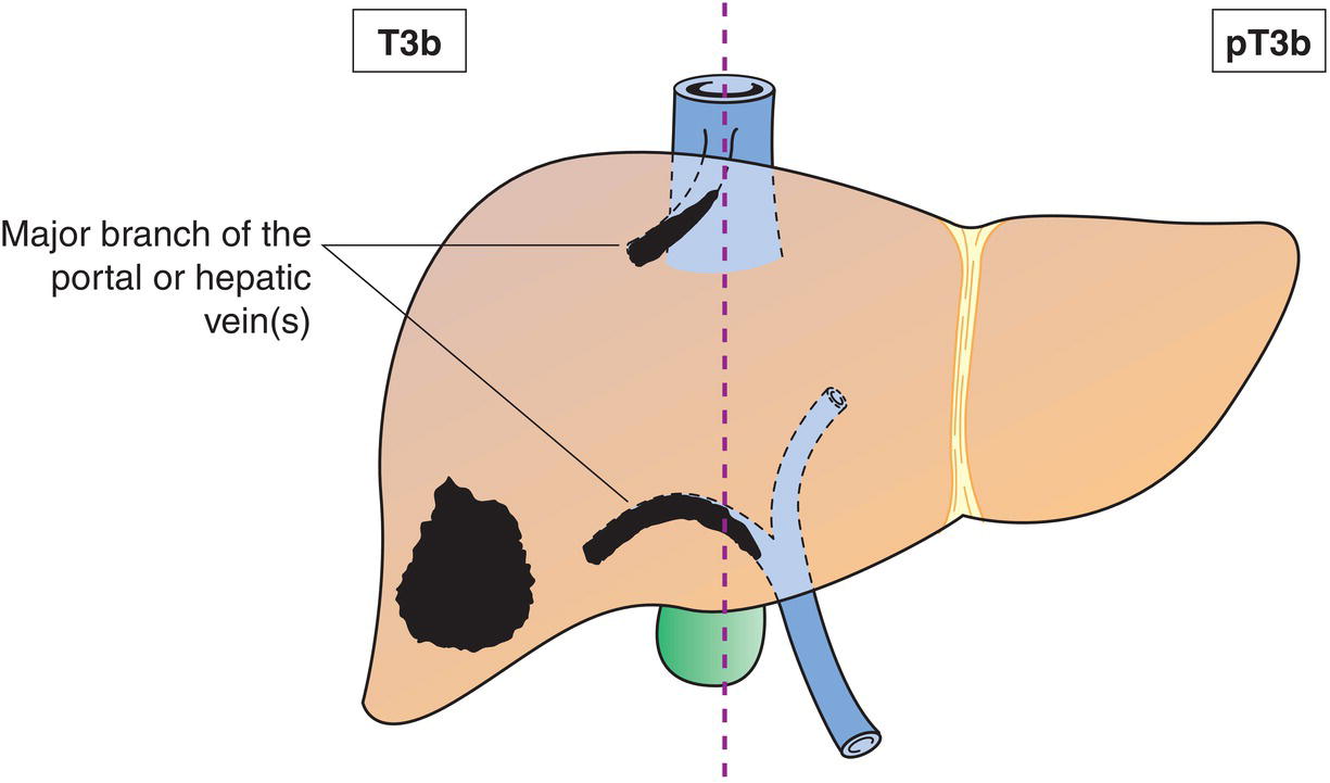 Schematic illustration of tumour(s) involving a major branch of the portal or hepatic vein or with direct invasion of adjacent organs, other than the gallbladder, or with perforation of visceral peritoneum.