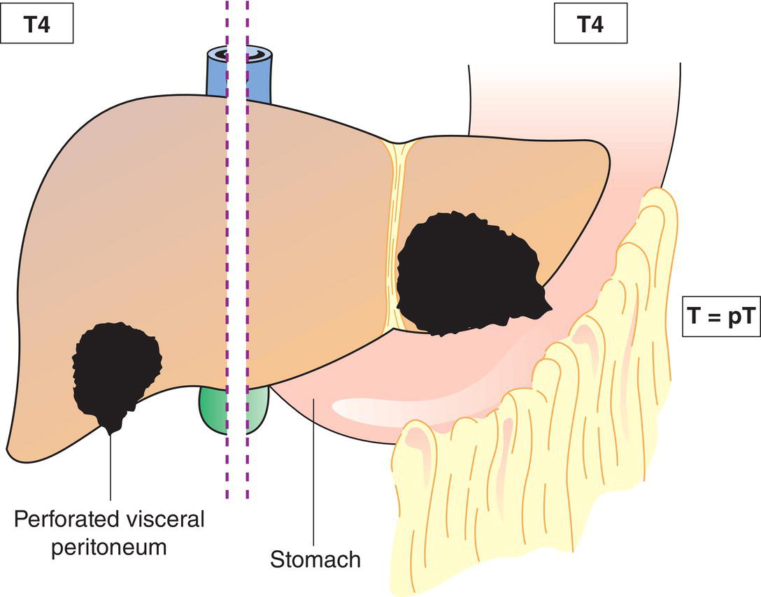 Schematic illustration of tumour(s) involving a major branch of the portal or hepatic vein or with direct invasion of adjacent organs (including the diaphragm), other than the gallbladder, or with perforation of visceral peritoneum.