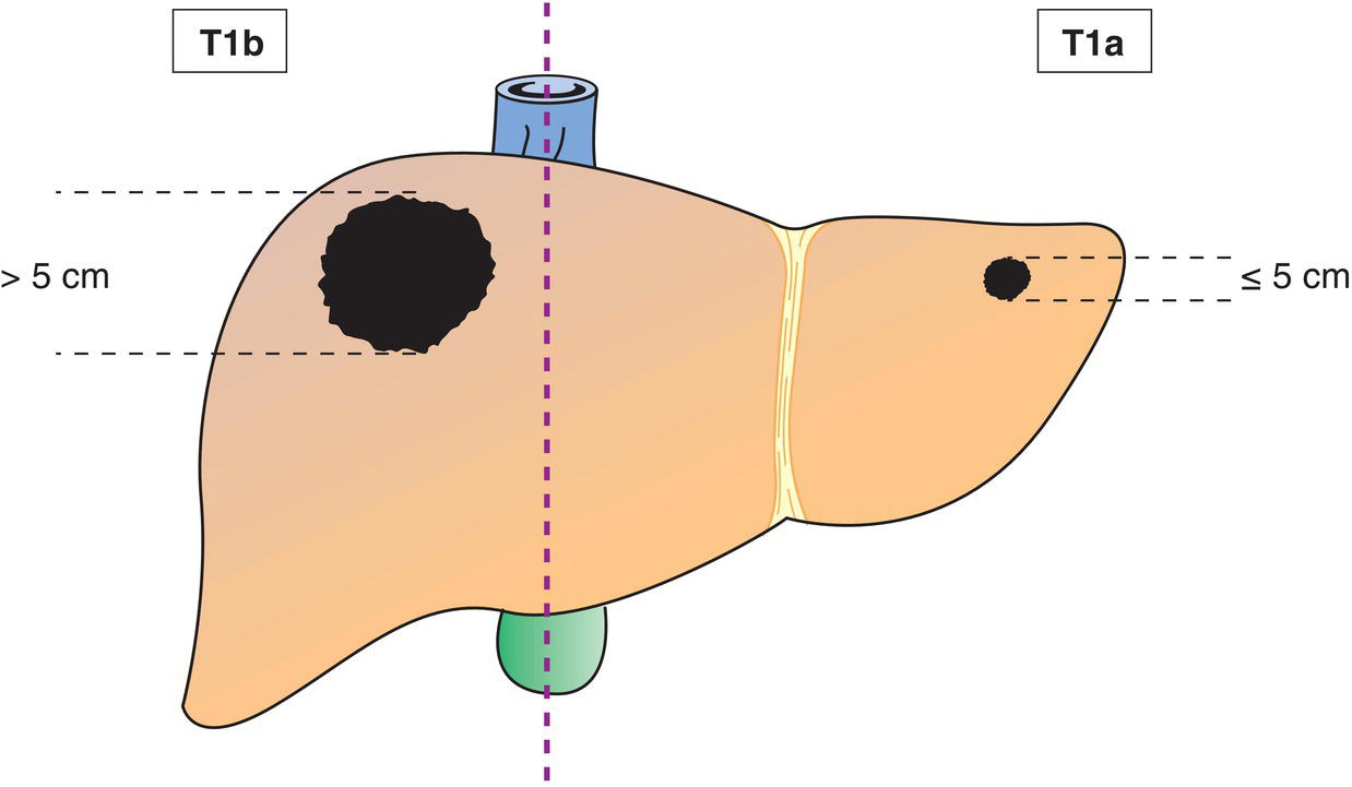 Schematic illustration of Solitary tumour 5 cm or less in greatest dimension without vascular
invasion.