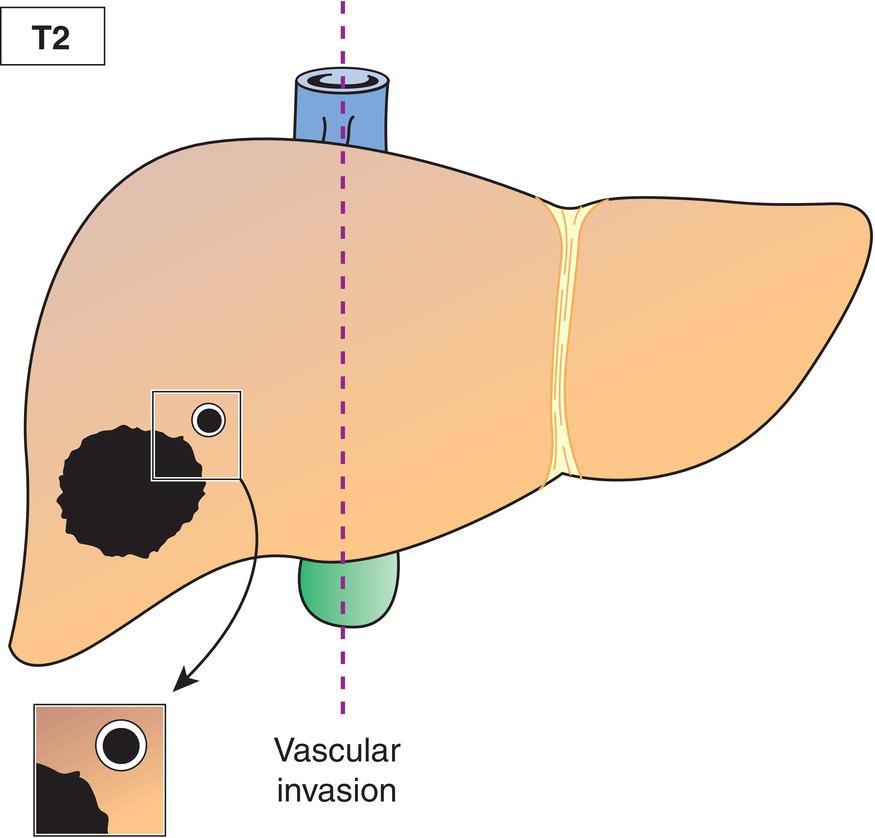 Schematic illustration of Solitary tumour with intrahepatic vascular invasion or multiple tumours, with or without vascular invasion.