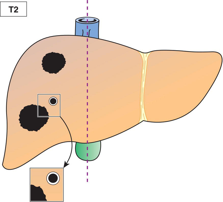 Schematic illustration of Solitary tumour with intrahepatic vascular invasion or multiple tumours, with or without vascular invasion.