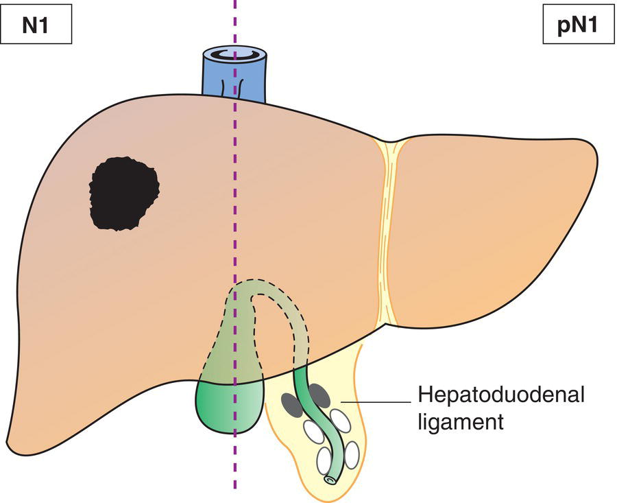 Schematic illustration of Regional lymph node metastasis.