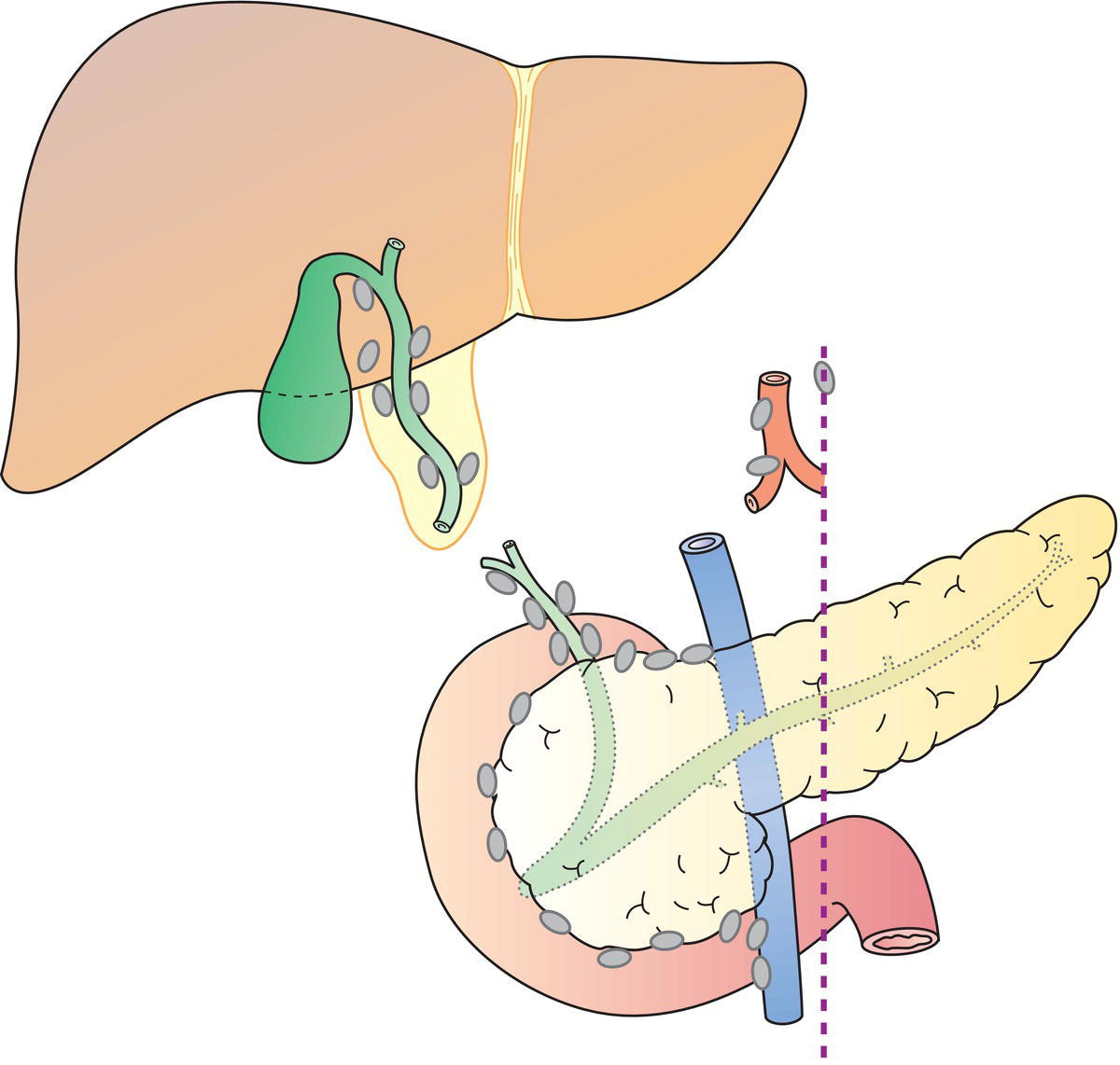 Schematic illustration of coeliac, periduodenal, peripancreatic and superior mesenteric artery node involvement is considered distant metastasis.