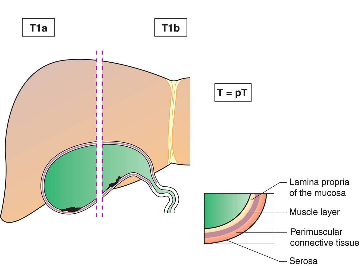 Schematic illustration of tumour invades lamina propria or muscular layer.