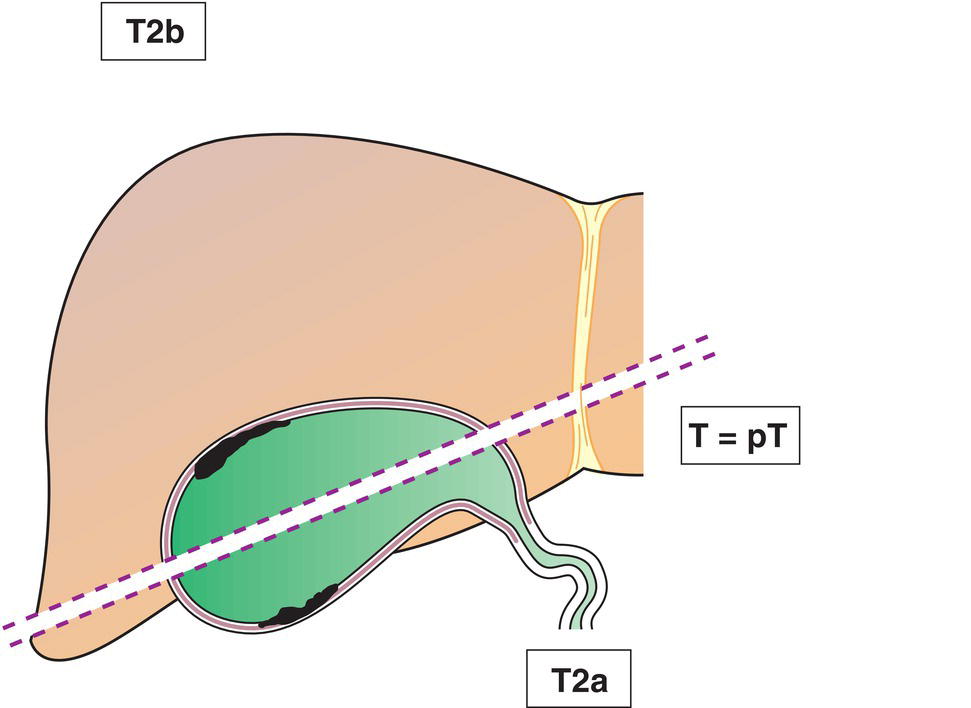 Schematic illustration of tumour invades perimuscular connective tissue; no extension beyond serosa or into liver.