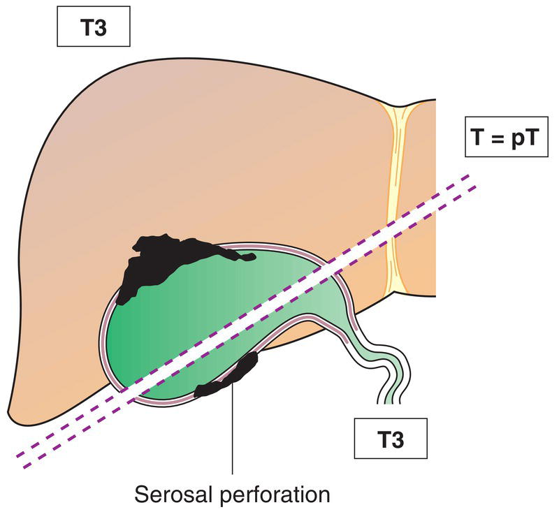 Schematic illustration of tumour perforates the serosa and directly invades the liver and one other adjacent organ or structure, such as stomach, duodenum, colon, pancreas, omentum, extrahepatic bile ducts.