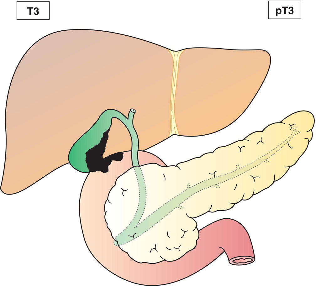 Schematic illustration of tumour perforates the serosa and directly invades the liver and one other adjacent organ or structure, such as stomach, duodenum, colon, pancreas, omentum, extrahepatic bile ducts.