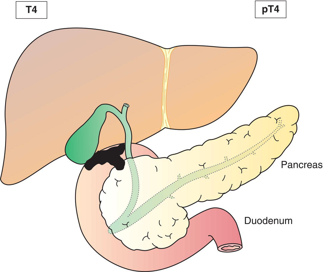 Schematic illustration of tumour invades main portal vein or hepatic artery or invades two or more extrahepatic organs or structures.