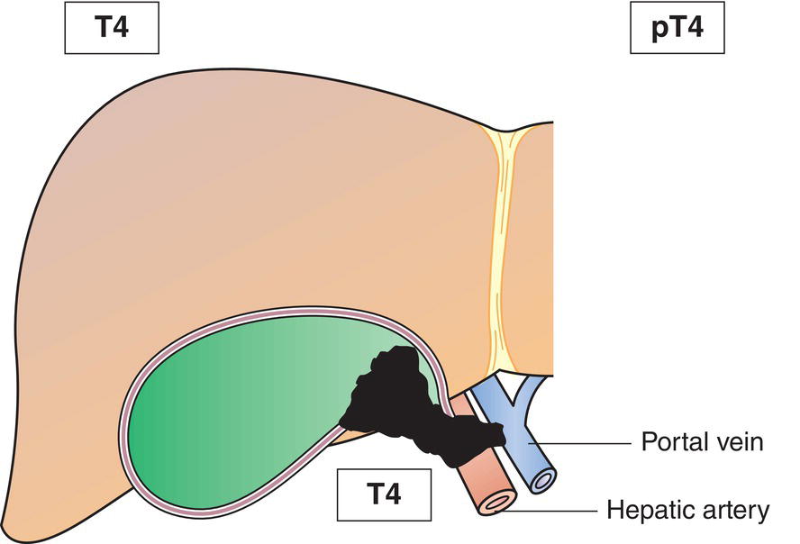 Schematic illustration of tumour invades main portal vein or hepatic artery or invades two or more extrahepatic organs or structures.