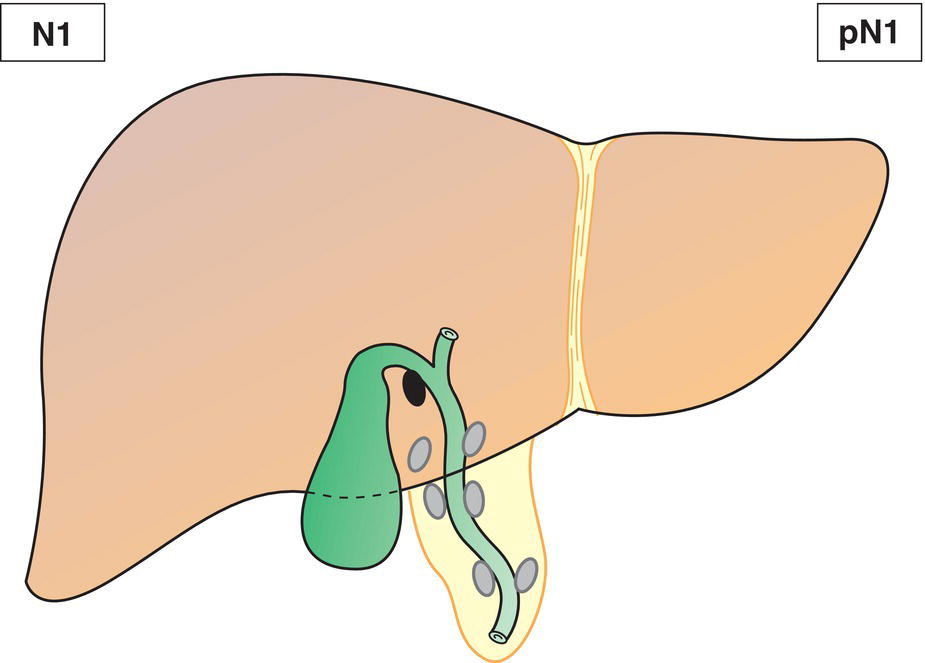 Schematic illustration of Metastases to 1-3 nodes.