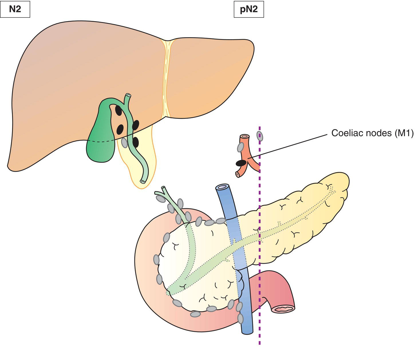 Schematic illustration of Metastases to 4 or more nodes.