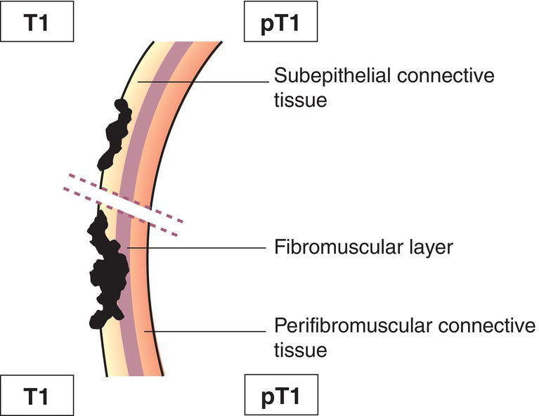 Schematic illustration of tumour confined to the bile duct, with extension up to the muscle layer or fibrous tissue.