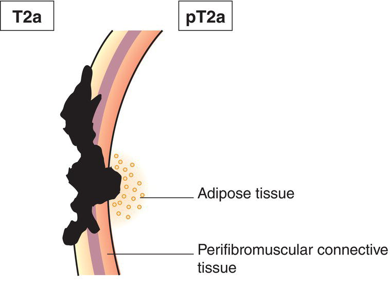 Schematic illustration of tumour invades beyond the wall of the bile duct to surrounding adipose tissue.