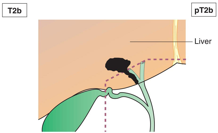 Schematic illustration of tumour invades adjacent hepatic parenchyma.