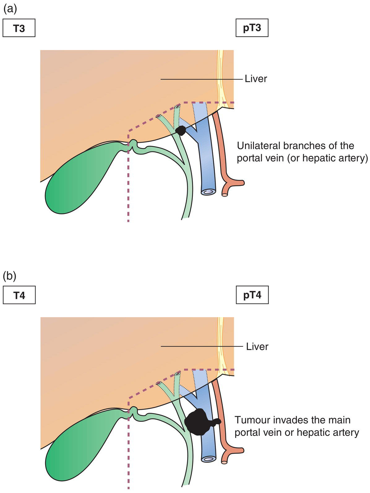 Schematic illustration of tumour invades unilateral branches of the portal vein or hepatic artery.