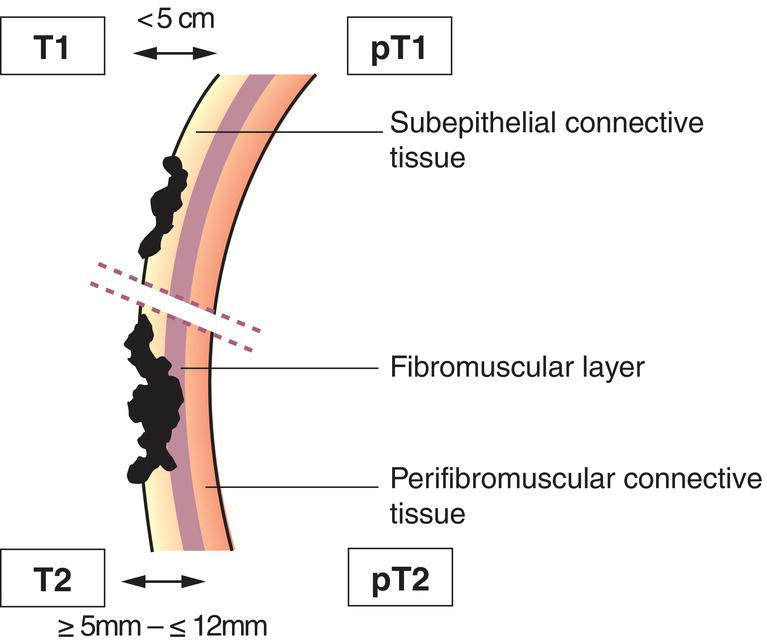 Schematic illustration of tumour invades bile duct wall to a depth of less than 5 mm.