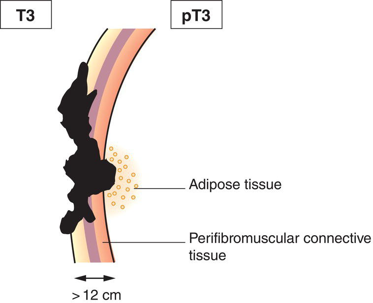 Schematic illustration of tumour invades bile duct wall to a depth of more than 12 mm.