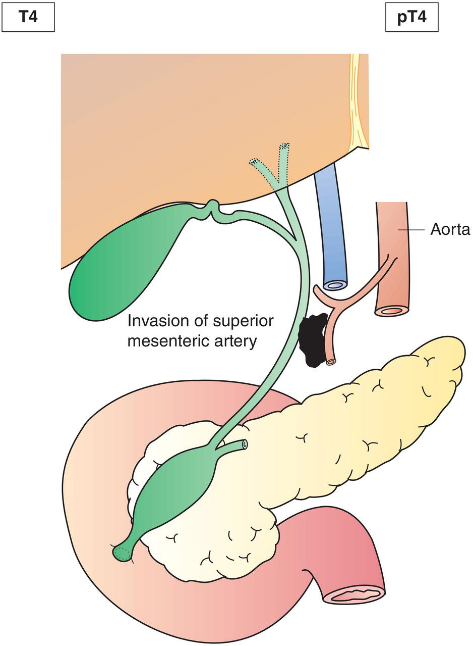 Schematic illustration of tumour involves the coeliac axis or the superior mesenteric artery.