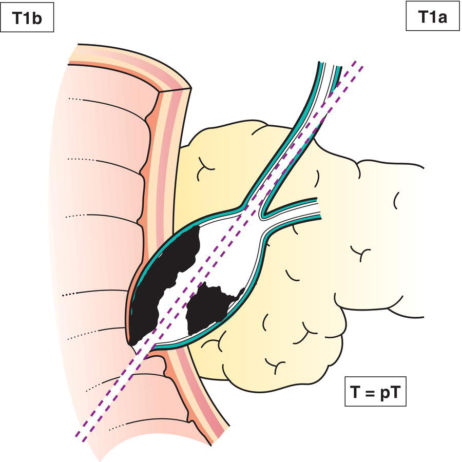 Schematic illustration of tumour limited to ampulla of Vater or sphincter of Oddi.