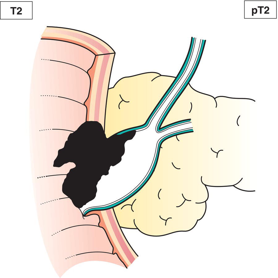 Schematic illustration of tumour invades beyond the sphincter of Oddi and into the duodenal submucosa.