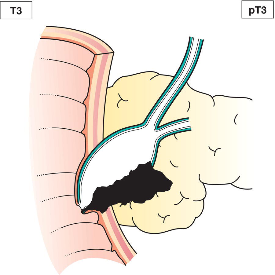 Schematic illustration of tumour invades pancreas or peripancreatic tissue.