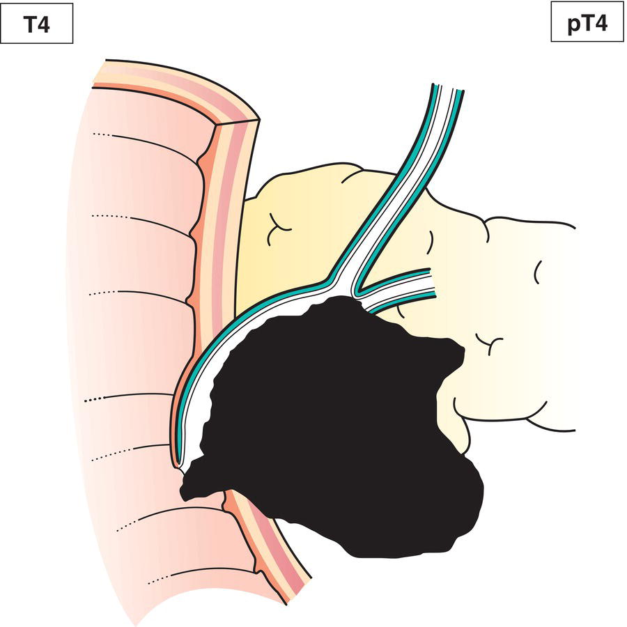 Schematic illustration of tumour with vascular involvement of the superior mesenteric artery or coeliac axis, or portal venous involvement that cannot be reconstructed.