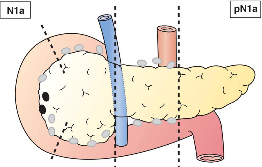 Schematic illustration of Metastasis in 1 or 3 regional lymph nodes.