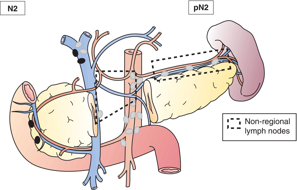 Schematic illustration of Metastasis in 4 or more regional lymph nodes.