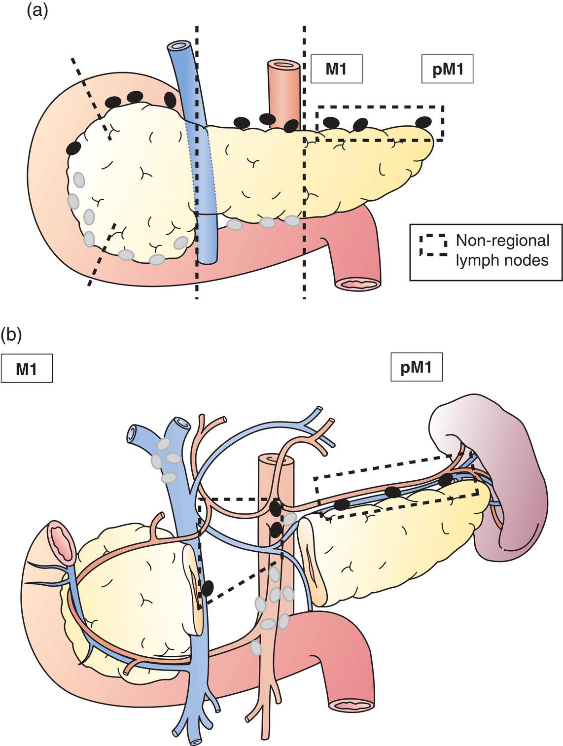 Schematic illustration of Distant metastasis.