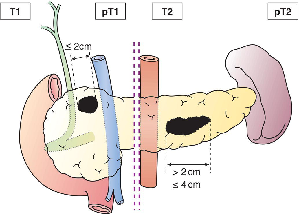 Schematic illustration of tumour limited to pancreas, more than 2 cm but no more than 4 cm in greatest dimension.