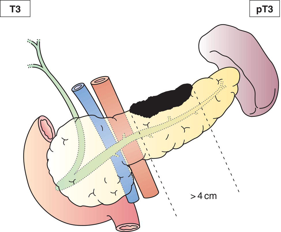 Schematic illustration of tumour limited to pancreas, more than 4 cm in greatest dimension.