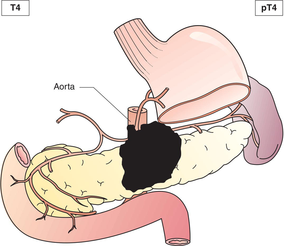 Schematic illustration of tumour involves coeliac axis, superior mesenteric artery and common hepatic artery.