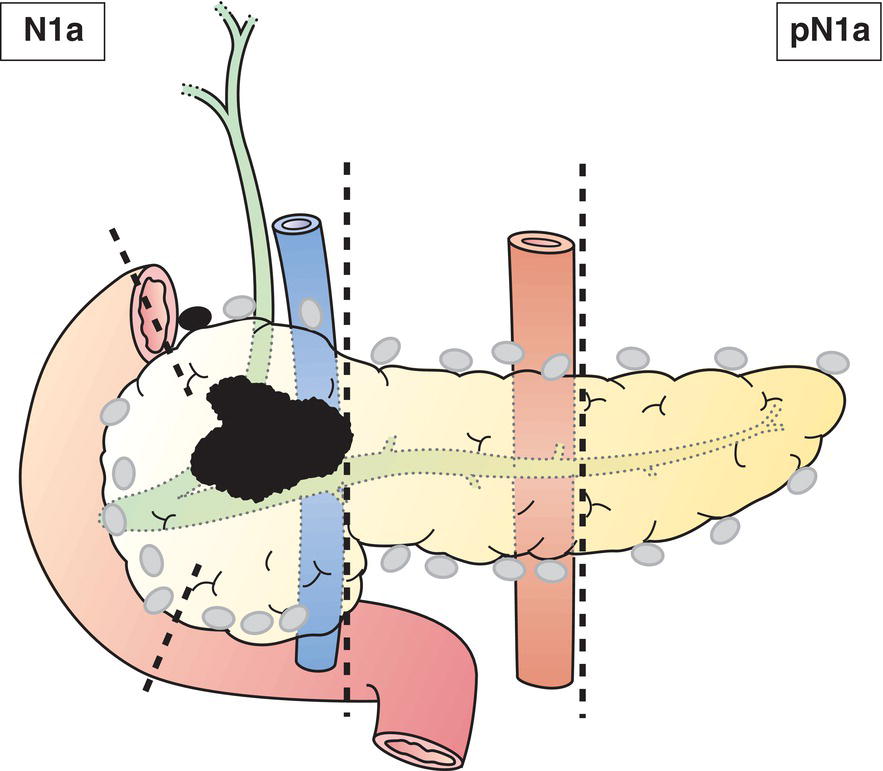 Schematic illustration of Metastases in 1 to 3 regional lymph node.