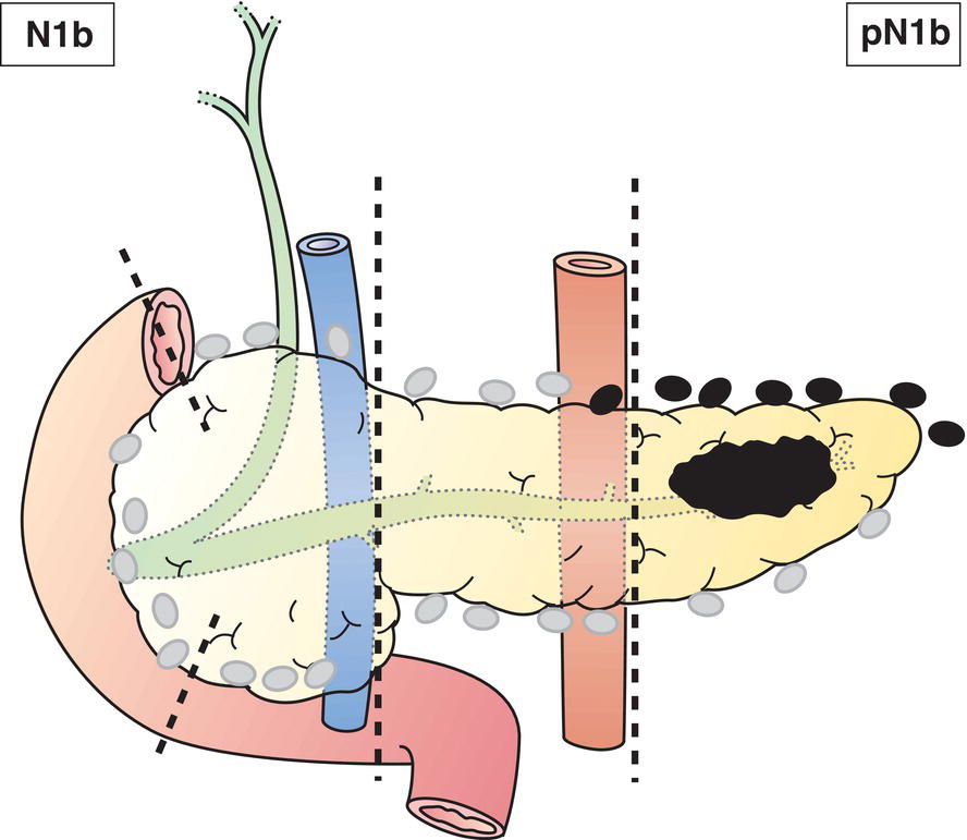 Schematic illustration of Metastases in 4 or more regional lymph nodes.