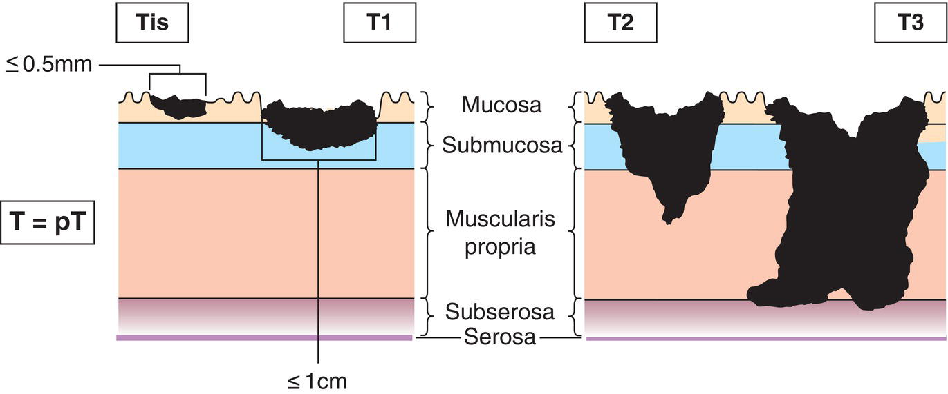 Schematic illustration of tumour invades the mucosa or submucosa and is no greater than 1 cm in greatest dimension.