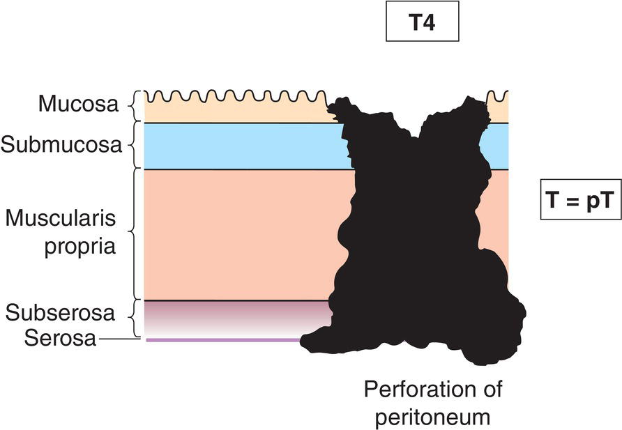 Schematic illustration of tumour perforates visceral peritoneum.