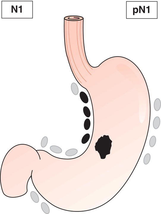 Schematic illustration of Regional lymph node metastasis.