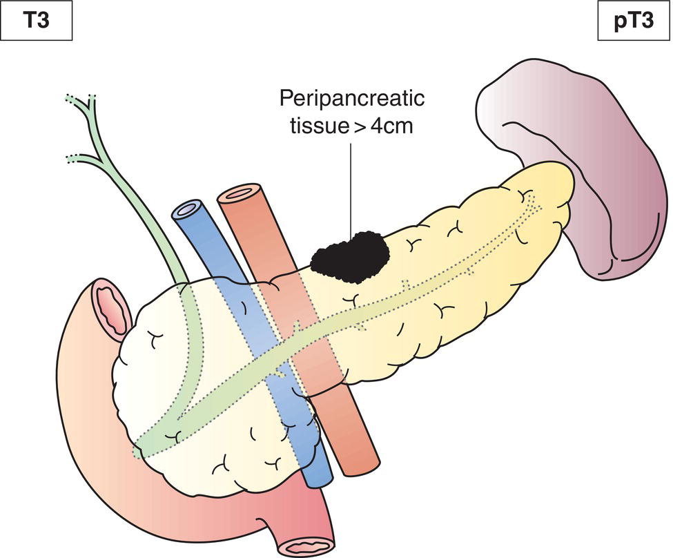 Schematic illustration of tumour limited to pancreas, more than 4 cm in greatest dimension.