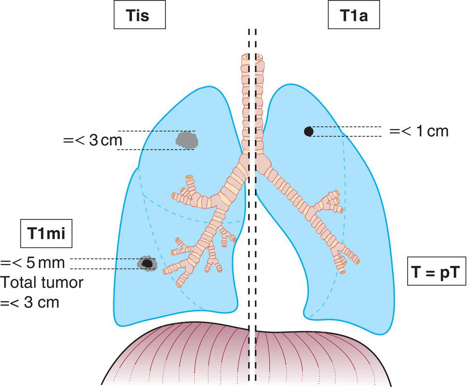 Schematic illustration of Adenocarcinoma in situ, Minimally invasive adenocarcinoma and Tumour 1 cm or less in greatest dimension.