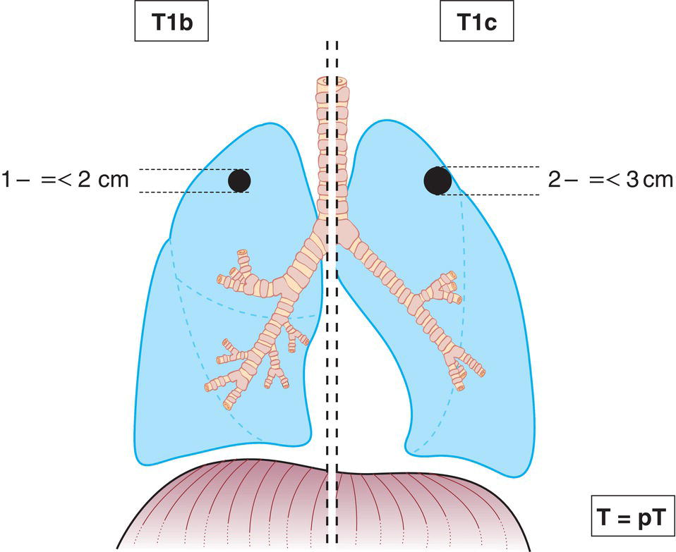 Schematic illustration of tumour more than 1 cm but not more than 2 cm in greatest dimension.