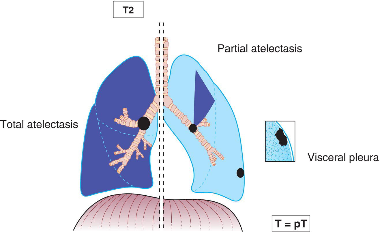 Schematic illustration of Involves main bronchus regardless of distance to the carina, but without involving the carina, Invades visceral pleura.