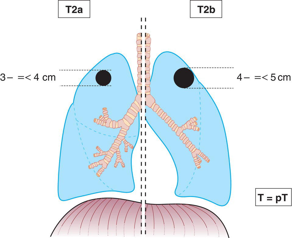 Schematic illustration of tumour more than 3 cm but not more than 4 cm in greatest dimension.