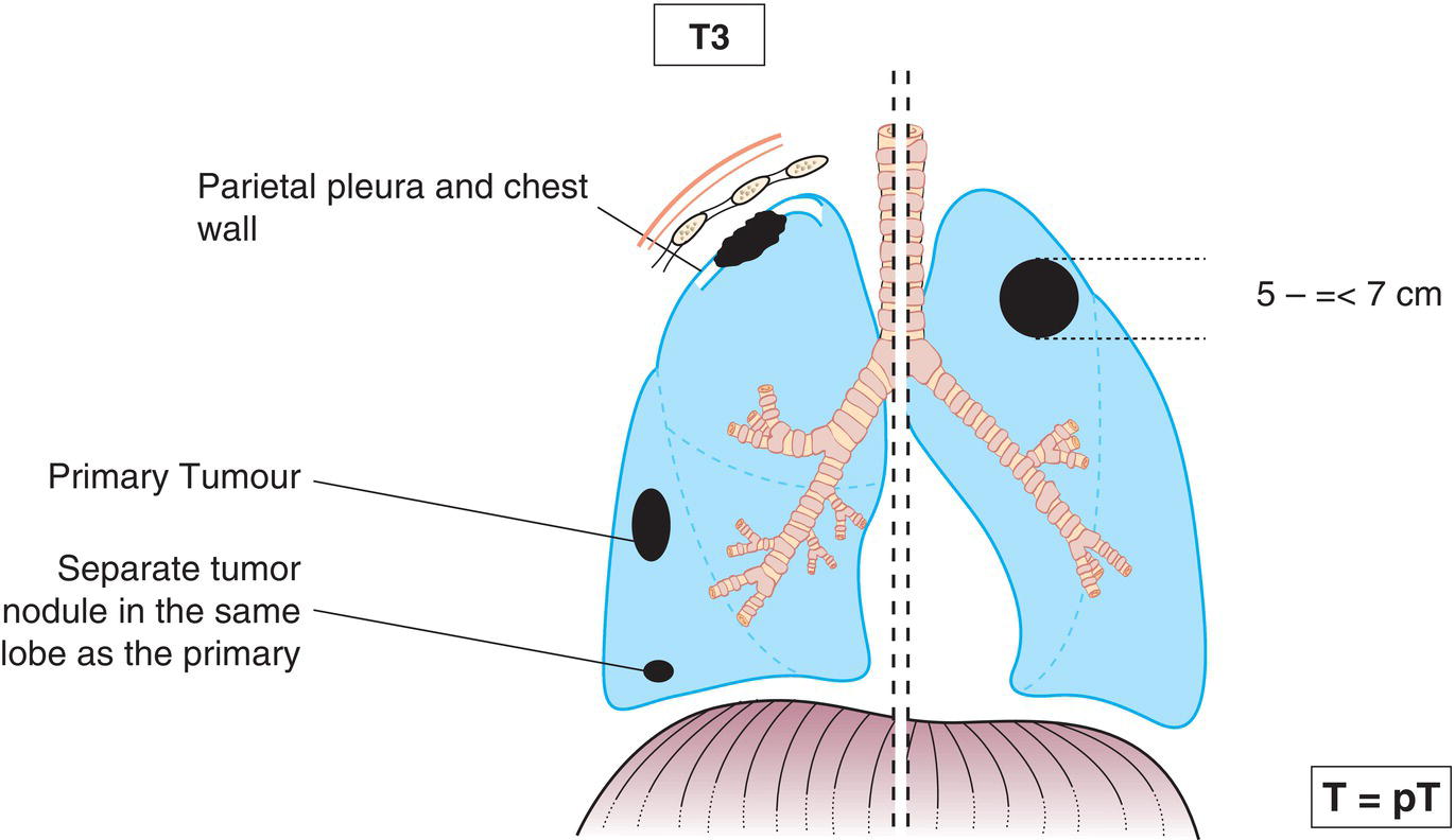 Schematic illustration of tumour more than 5 cm but not more than 7 cm in greatest dimension or one that directly invades any of the following: chest wall (including superior sulcus tumours), phrenic nerve, parietal pericardium; or associated separate tumour nodule(s) in the same lobe as the primary.